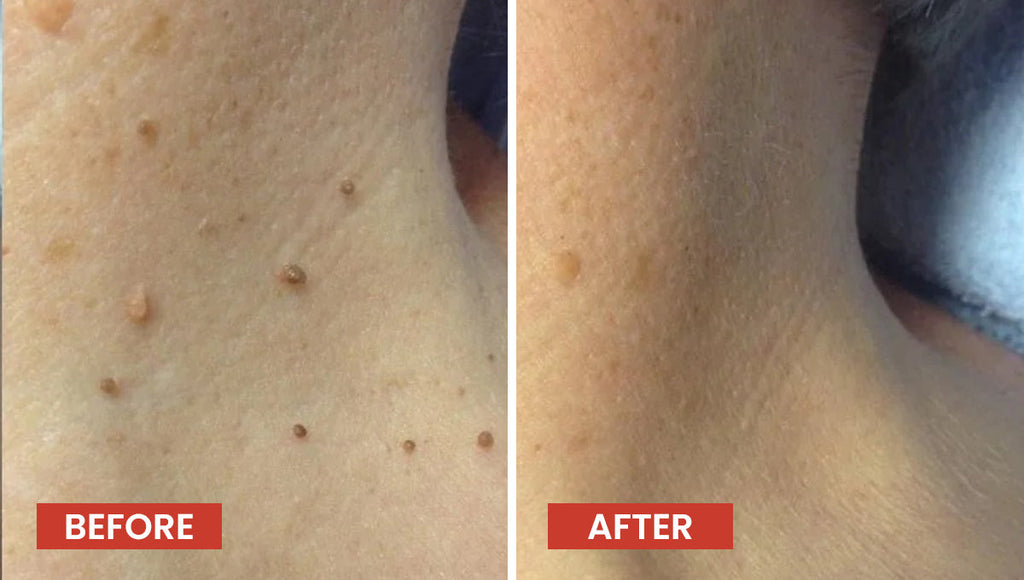 Derma Smooth Skin Tag Removal Patch - 72 Patches